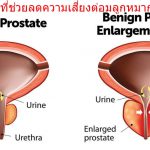 4 สารอาหารที่ช่วยลดความเสี่ยงต่อมลูกหมากโตในผู้ชาย