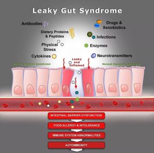 การปล่อยให้ลำไส้รั่ว หรือ Leaky gut นำไปสู่การเกิดโรคอะไรบ้าง