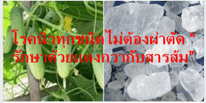 โรคนิ่วทุกชนิดไม่ต้องผ่าตัด “ รักษาด้วยแตงกวากับสารส้ม”