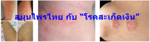 สมุนไพรไทย กับ “โรคสะเก็ดเงิน”