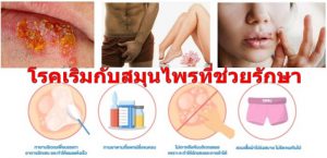 โรคเริมกับสมุนไพรที่ช่วยรักษา