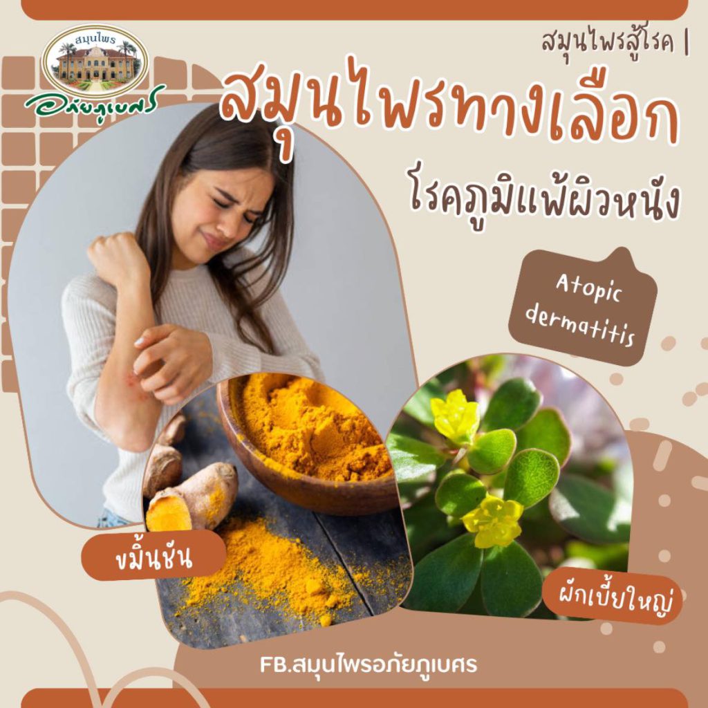 โรคภูมิแพ้ผิวหนัง (Atopic dermatitis) 